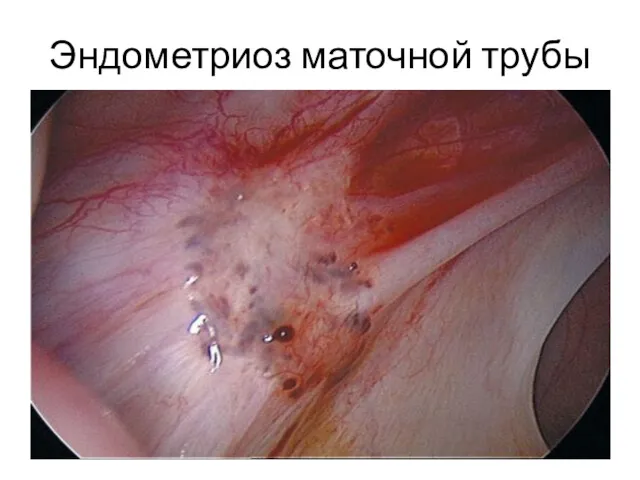 Эндометриоз маточной трубы