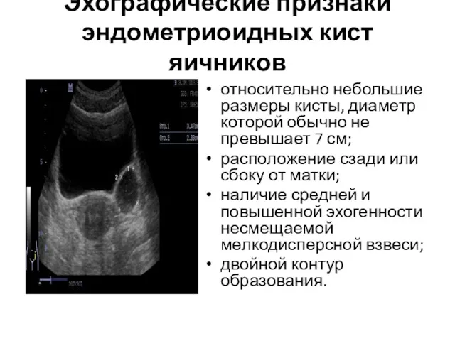 Эхографические признаки эндометриоидных кист яичников относительно небольшие размеры кисты, диаметр которой обычно не