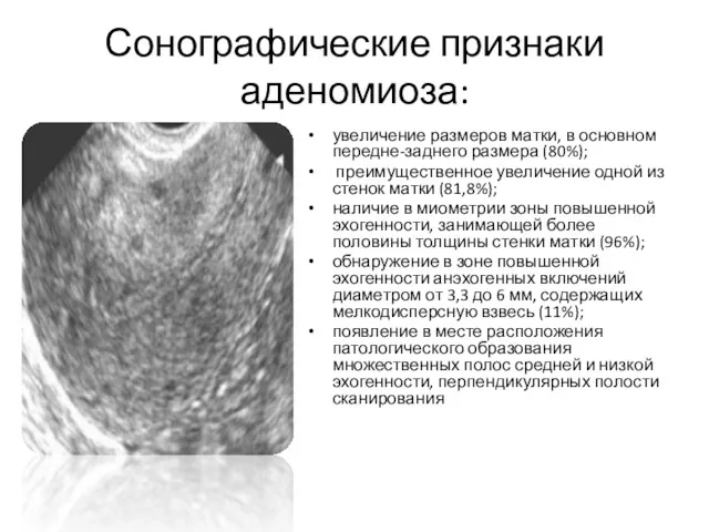 Сонографические признаки аденомиоза: увеличение размеров матки, в основном передне-заднего размера (80%); преимущественное увеличение