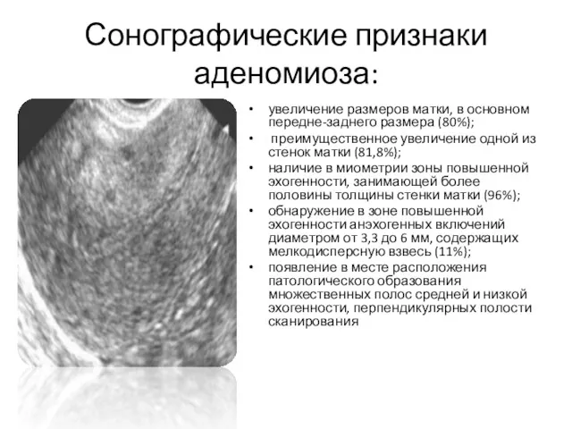 Сонографические признаки аденомиоза: увеличение размеров матки, в основном передне-заднего размера