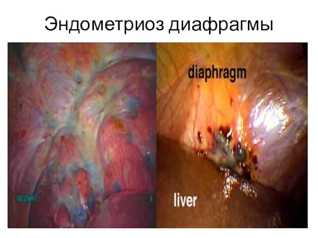 Эндометриоз диафрагмы