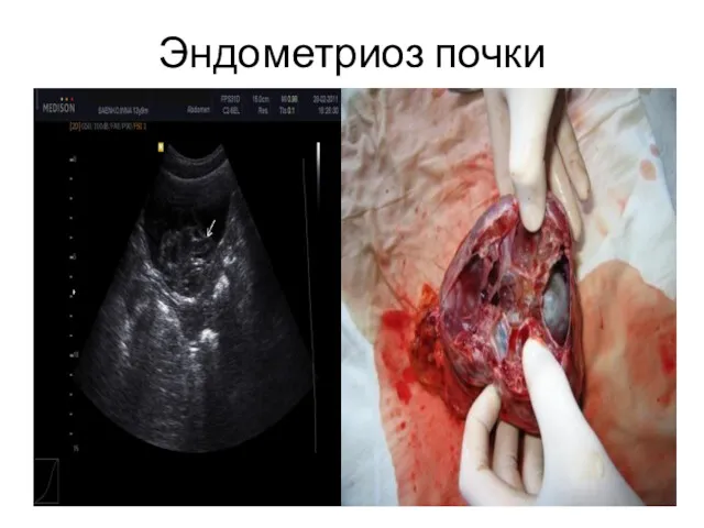 Эндометриоз почки