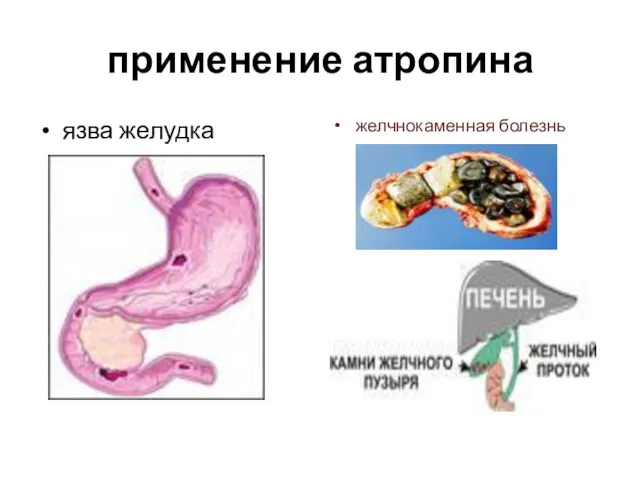 применение атропина язва желудка желчнокаменная болезнь