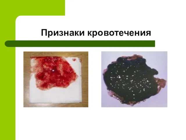 Признаки кровотечения