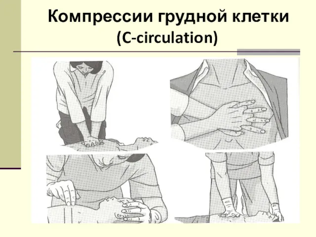 Компрессии грудной клетки (C-circulation)