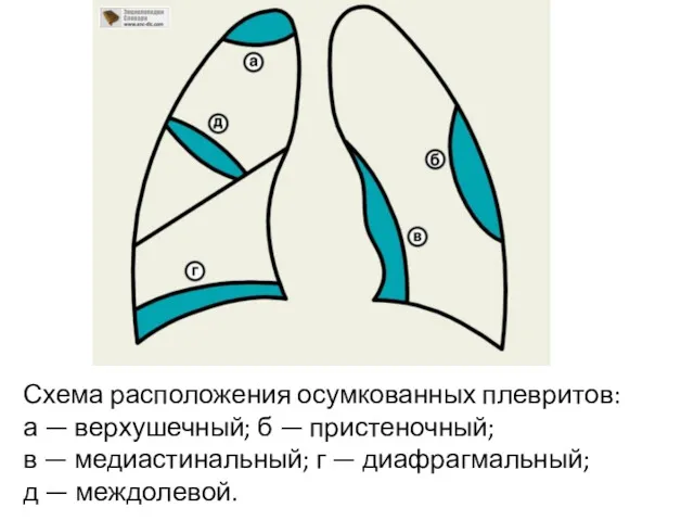 Схема расположения осумкованных плевритов: а — верхушечный; б — пристеночный;