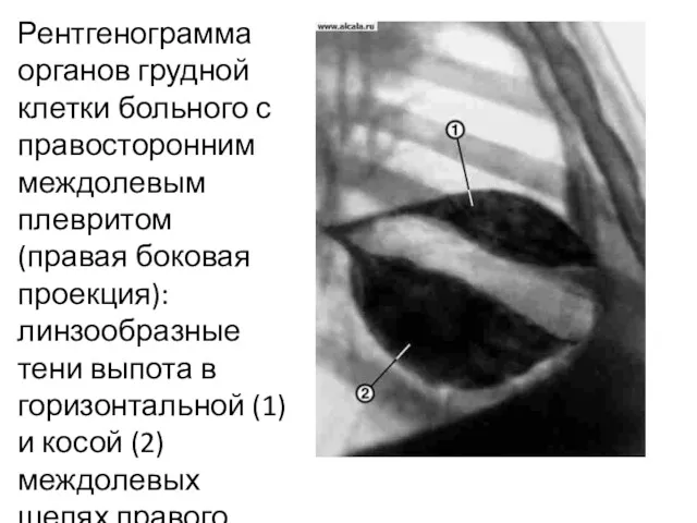 Рентгенограмма органов грудной клетки больного с правосторонним междолевым плевритом (правая