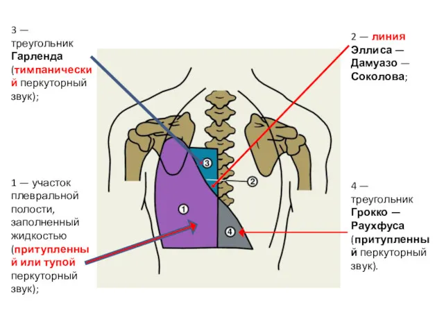 1 — участок плевральной полости, заполненный жидкостью (притупленный или тупой