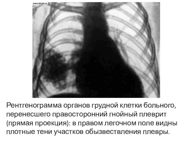 Рентгенограмма органов грудной клетки больного, перенесшего правосторонний гнойный плеврит (прямая