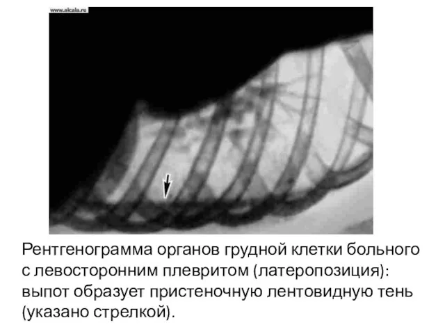 Рентгенограмма органов грудной клетки больного с левосторонним плевритом (латеропозиция): выпот образует пристеночную лентовидную тень (указано стрелкой).