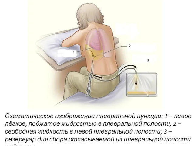 Схематическое изображение плевральной пункции: 1 – левое лёгкое, поджатое жидкостью