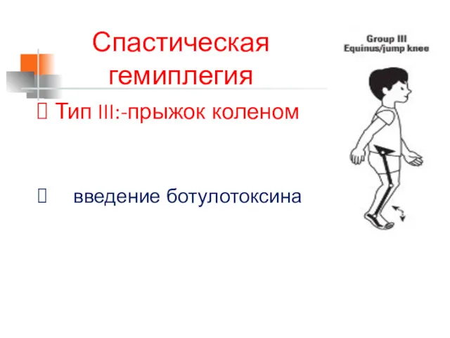 Спастическая гемиплегия Тип III:-прыжок коленом введение ботулотоксина