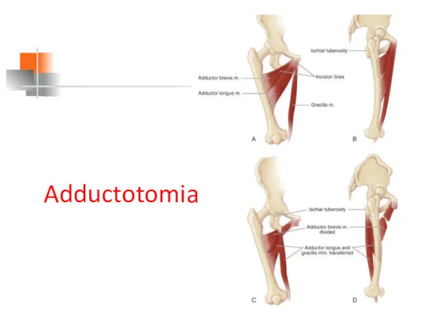 Adductotomia