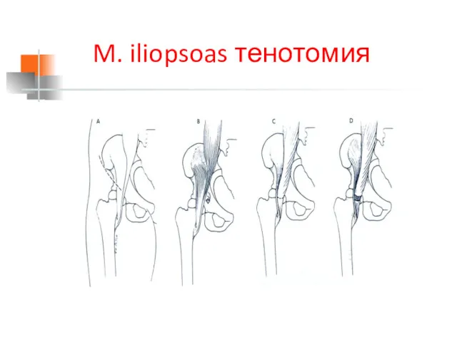 M. iliopsoas тенотомия