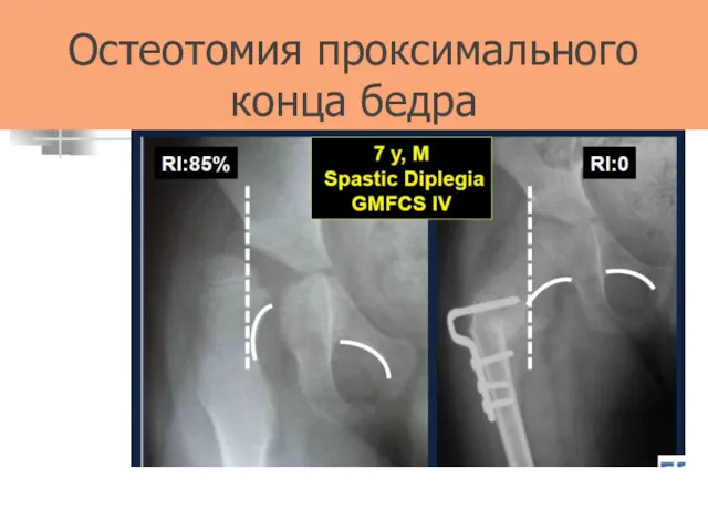 Остеотомия проксимального конца бедра