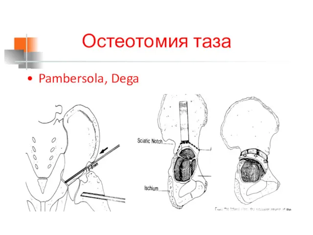 Остеотомия таза Pambersola, Dega