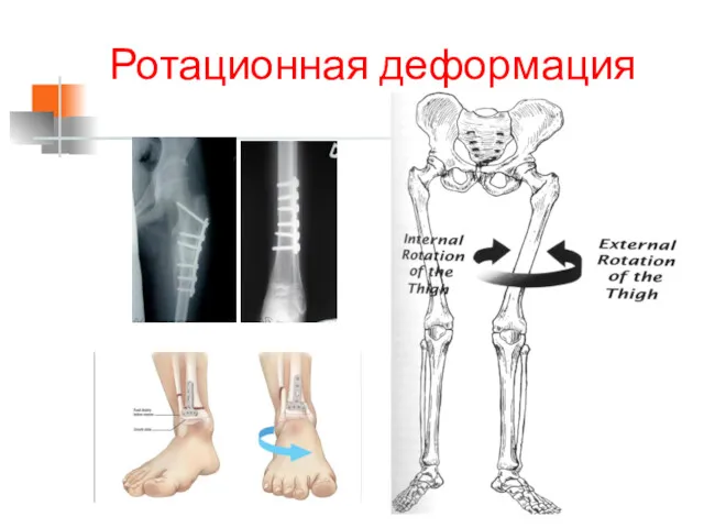 Ротационная деформация