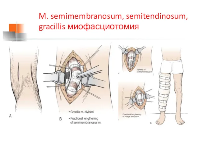 M. semimembranosum, semitendinosum, gracillis миофасциотомия