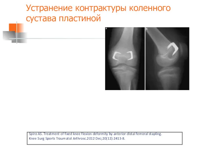 Устранение контрактуры коленного сустава пластиной Spiro AS. Treatment of fixed