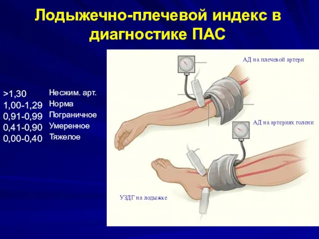 Лодыжечно-плечевой индекс в диагностике ПАС Несжим. арт. Норма Пограничное Умеренное