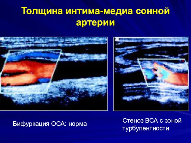 Толщина интима-медиа сонной артерии Бифуркация ОСА: норма Стеноз ВСА с зоной турбулентности