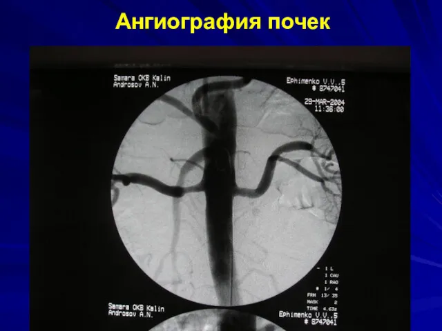 Ангиография почек