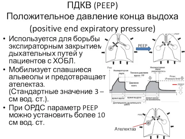 ПДКВ (PEEP) Положительное давление конца выдоха (positive end expiratory pressure)