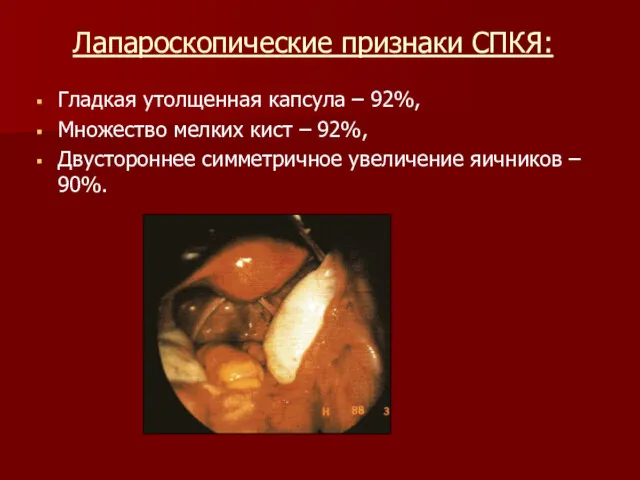 Лапароскопические признаки СПКЯ: Гладкая утолщенная капсула – 92%, Множество мелких кист – 92%,