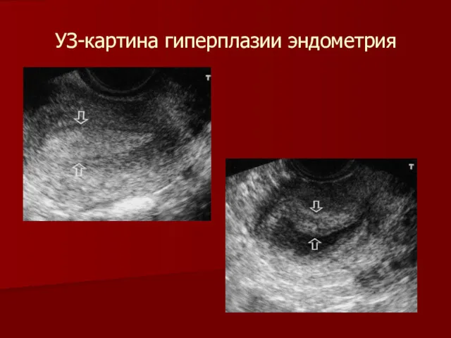 УЗ-картина гиперплазии эндометрия