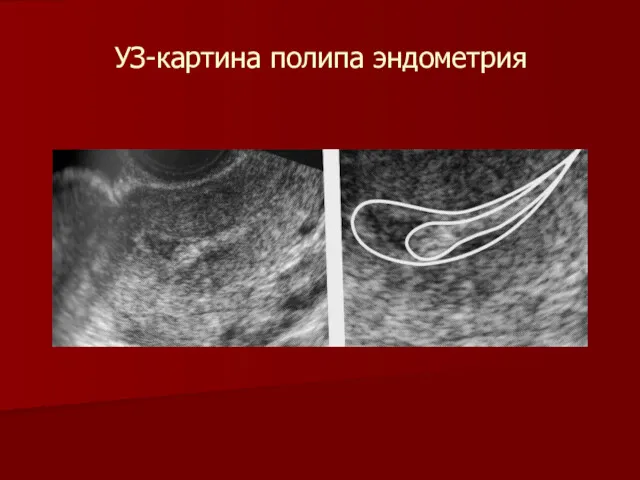 УЗ-картина полипа эндометрия