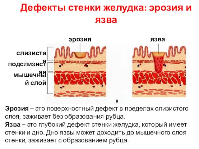 Дефекты стенки желудка: эрозия и язва Эрозия – это поверхностный