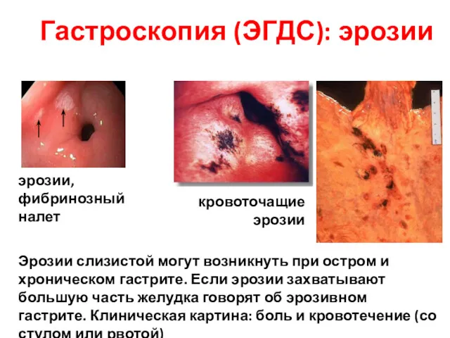 Гастроскопия (ЭГДС): эрозии кровоточащие эрозии Эрозии слизистой могут возникнуть при