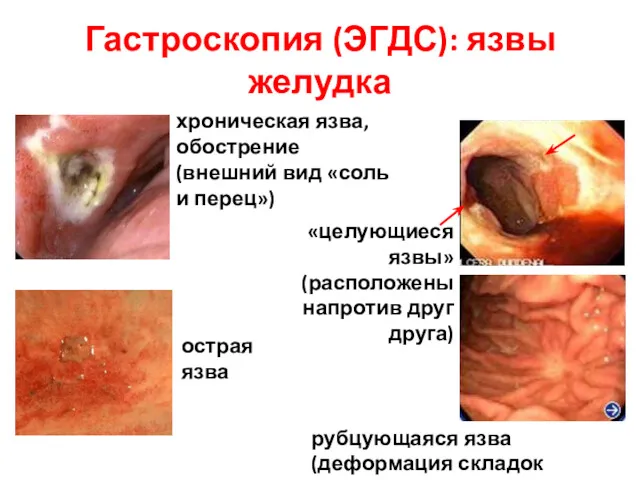 Гастроскопия (ЭГДС): язвы желудка хроническая язва, обострение (внешний вид «соль