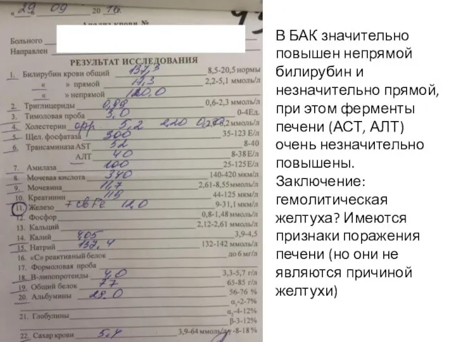 В БАК значительно повышен непрямой билирубин и незначительно прямой, при