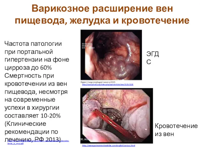 Варикозное расширение вен пищевода, желудка и кровотечение Частота патологии при