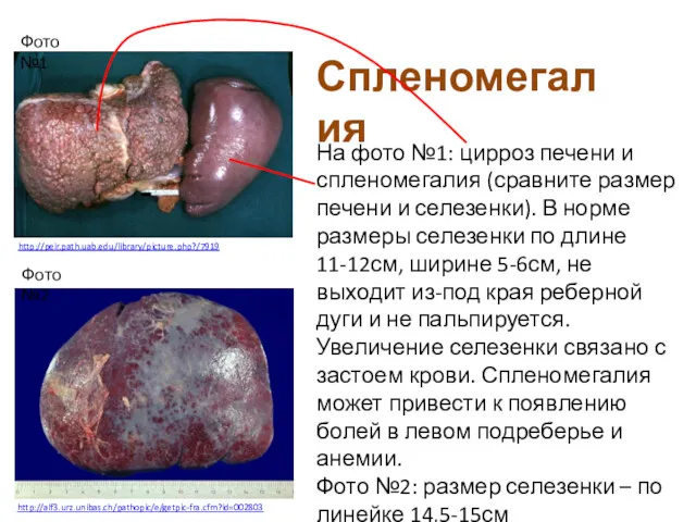 Спленомегалия На фото №1: цирроз печени и спленомегалия (сравните размер