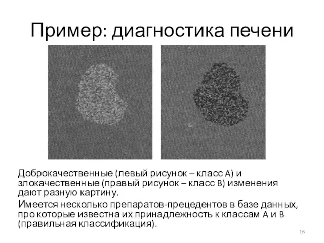 Пример: диагностика печени Доброкачественные (левый рисунок – класс A) и