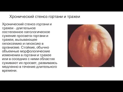 Хронический стеноз гортани и трахеи Хронический стеноз гортани и трахеи - длительное постепенное
