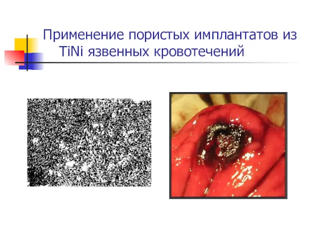 Применение пористых имплантатов из TiNi язвенных кровотечений