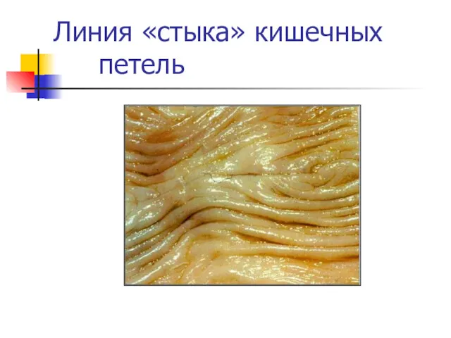 Линия «стыка» кишечных петель