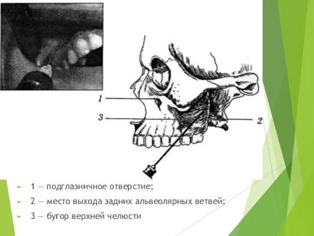1 — подглазничное отверстие; 2 — место выхода задних альвеолярных ветвей; 3 — бугор верхней челюсти