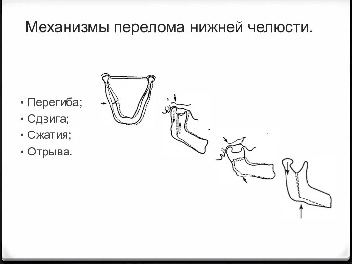 Перегиба; Сдвига; Сжатия; Отрыва. Механизмы перелома нижней челюсти.