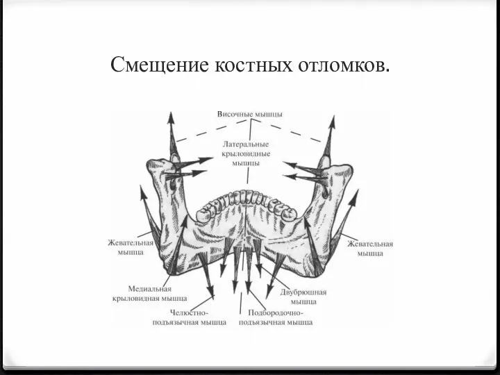 Смещение костных отломков.