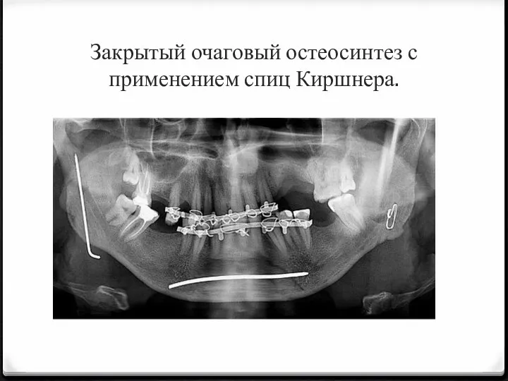 Закрытый очаговый остеосинтез с применением спиц Киршнера.