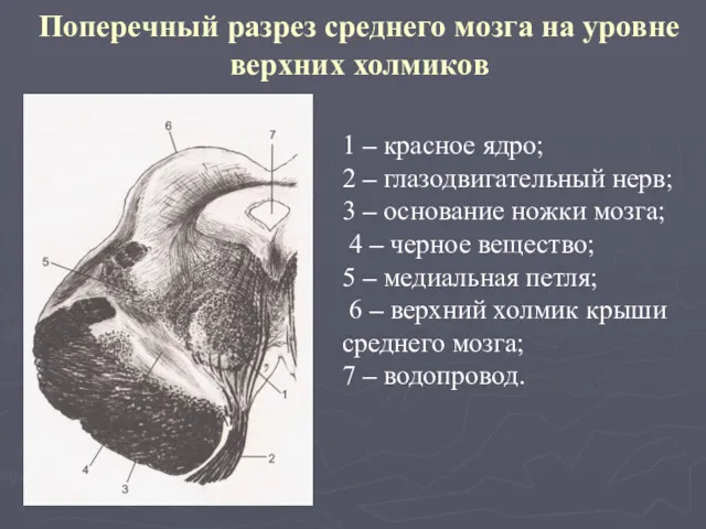 Поперечный разрез среднего мозга на уровне верхних холмиков 1 –