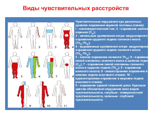 Виды чувствительных расстройств Чувствительные нарушения при различных уровнях поражения нервной