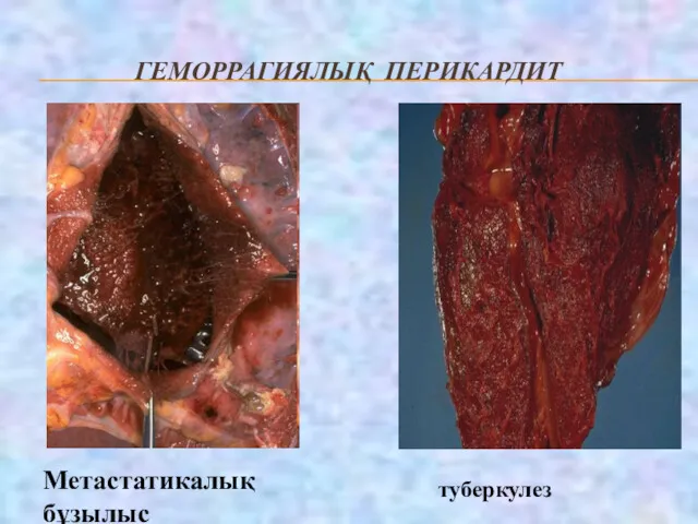 ГЕМОРРАГИЯЛЫҚ ПЕРИКАРДИТ Метастатикалық бұзылыс туберкулез