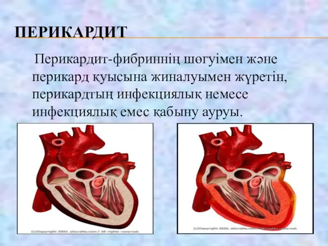 ПЕРИКАРДИТ Перикардит-фибриннің шөгуімен және перикард қуысына жиналуымен жүретін, перикардтың инфекциялық немесе инфекциялық емес қабыну ауруы.