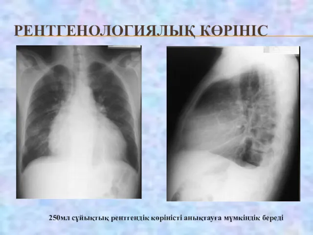 РЕНТГЕНОЛОГИЯЛЫҚ КӨРІНІС 250мл сұйықтық рентгендік көріністі анықтауға мүмкіндік береді