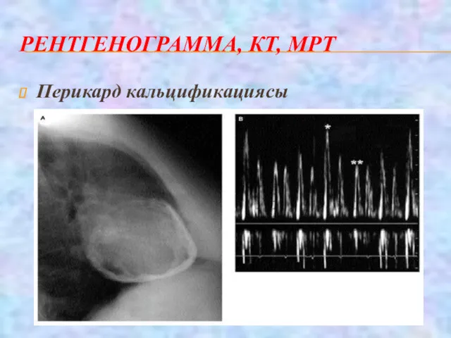 РЕНТГЕНОГРАММА, КТ, МРТ Перикард кальцификациясы